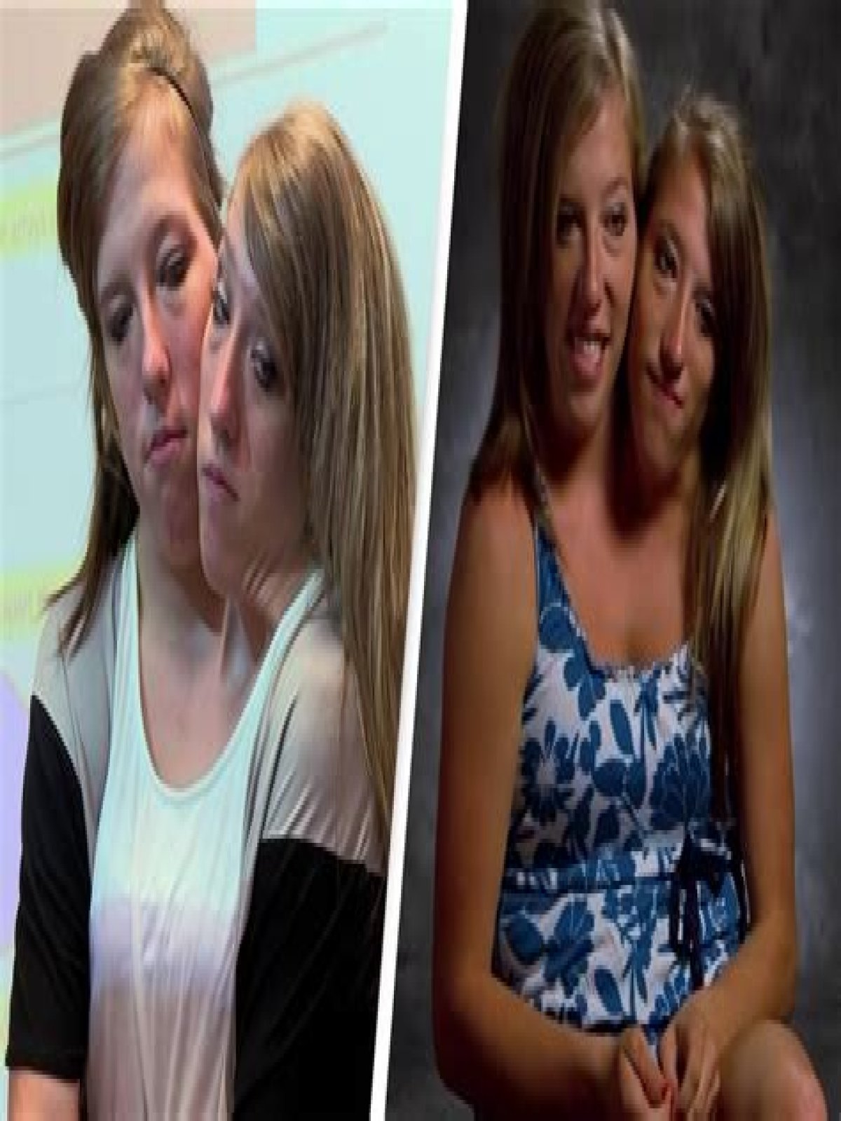 Are Abby and Brittany Hensel still conjoined?